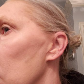 Blue Water Spa - After second treatment - Medical Spas Near Me - Raleigh, North Carolina