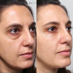 beyond AESTHETICS - Patient received under eye filler using Juvederm.