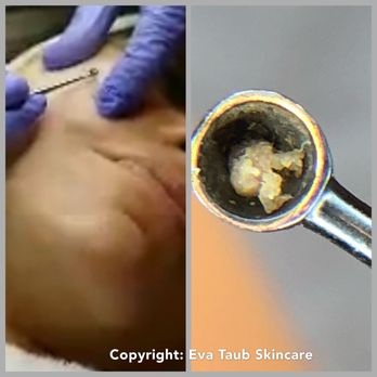 Eva Taub Skin Renewal Method - Extraction of black heads. - Skin Care Near Me - Newnan, Georgia Eva Taub Skin Renewal Method - Extraction of black heads. - Skin Care Near Me - Newnan, Georgia