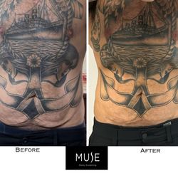 Muse Body Sculpting - Saggy skin? Tighten and tone your skin!