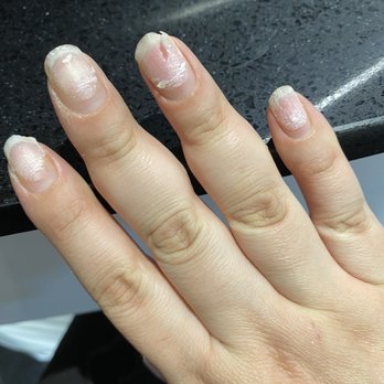 JM Nail Studio - After nails were ripped of with another bail tip - Nail Salons Near Me - Clayton, California JM Nail Studio - After nails were ripped of with another bail tip - Nail Salons Near Me - Clayton, California