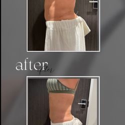 Ana's Touch Massage and Body Sculpting - Fat Cavitation results after 1 session