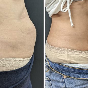 Lumiskins - Body contouring - Skin Care Near Me - Thornhill, Ontario