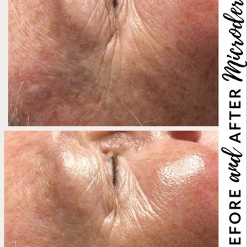 Love Your Skin - After only 1 microderm treatment! - Skin Care Near Me - Arvada, Colorado