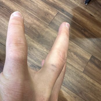 Newhope Laser Skin Care: Phuong Tien, MD - Ring tattoo - Tattoo Removal Near Me - Westminster, California Newhope Laser Skin Care: Phuong Tien, MD - Ring tattoo - Tattoo Removal Near Me - Westminster, California