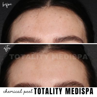 Chemical Peel - Have you ever wondered how some celebrities suddenly look years younger without going under the knife? The secret to it all are chemical peels, which offer beautifying results with no surgery involved. By invigorating the collagen, they tighten the texture of your skin to fight fine lines, wrinkles, discoloration and the other major signs of aging for a younger, healthier look without all the fuss or recovery time. Chemical Peel - Have you ever wondered how some celebrities suddenly look years younger without going under the knife? The secret to it all are chemical peels, which offer beautifying results with no surgery involved. By invigorating the collagen, they tighten the texture of your skin to fight fine lines, wrinkles, discoloration and the other major signs of aging for a younger, healthier look without all the fuss or recovery time.