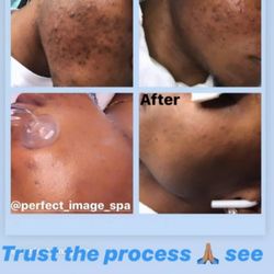 Perfect Image Spa - Before and after photos of our client