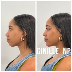 Ginille Beauty Aesthetics - Cheeks and chin filler