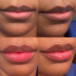 Lip filler by Breyonna. 1 mL Restylane Defyne Lip filler by Breyonna. 1 mL Restylane Defyne