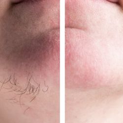 Electrolysis by Danielle