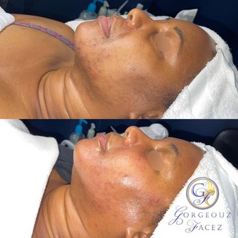 Gorgeouz Facez Spa - Results less than six months - Makeup Artists Near Me - Tamarac, Florida Gorgeouz Facez Spa - Results less than six months - Makeup Artists Near Me - Tamarac, Florida
