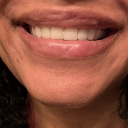 Summit MedAesthetics - This is what I was left with after the healing period. Lumps and bumps.
