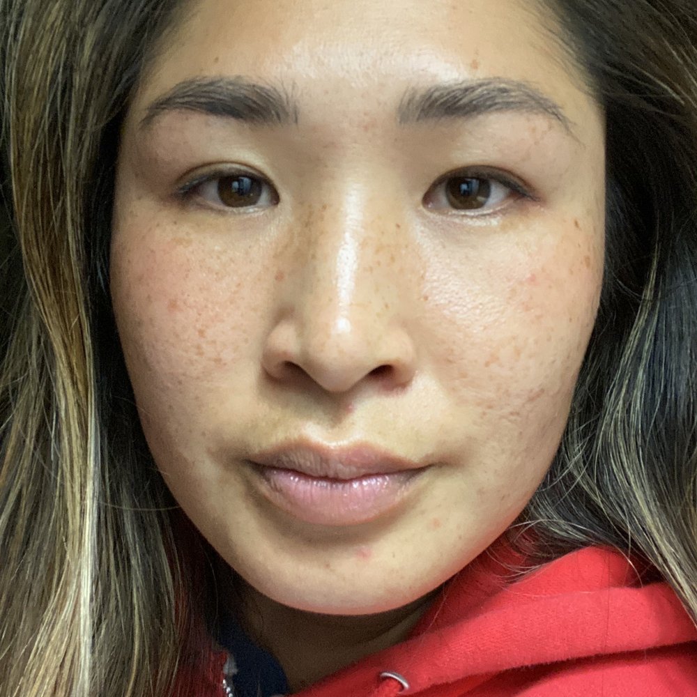 Before lots of freckles Before lots of freckles