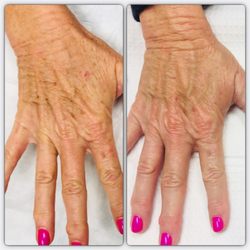 RFMG Aesthetics - Eliminate the age spots with IPL.
