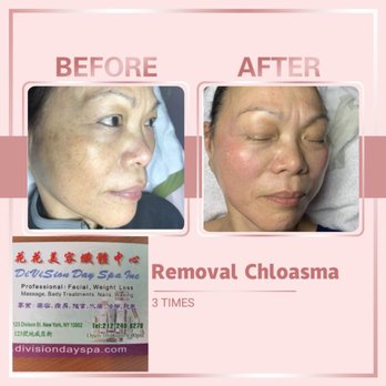 Division Day Spa - REMOVAL Chloasma 3 TIMES - Day Spas Near Me - New York, New York Division Day Spa - REMOVAL Chloasma 3 TIMES - Day Spas Near Me - New York, New York
