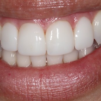 Implantasmile - After - Cosmetic Dentists Near Me - Glendora, California
