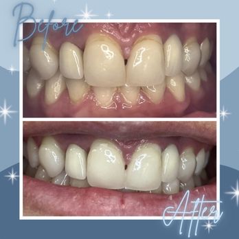 Soft Touch Teeth Whitening - West Jordan - Before & After. - Teeth Whitening Near Me - West Jordan, Utah Soft Touch Teeth Whitening - West Jordan - Before & After. - Teeth Whitening Near Me - West Jordan, Utah