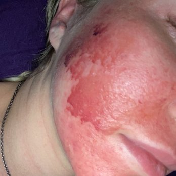 Utah Stem Cells - Chemical burn from Utah stem cells - Medical Spas Near Me - Sandy, Utah