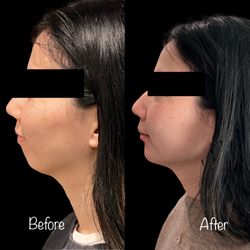 Mojdeh Shayestehfar, DDS - Linden Dental Care - Chin augmentation using Voluma