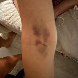 Quest Diagnostics - My arm where my elbow folds