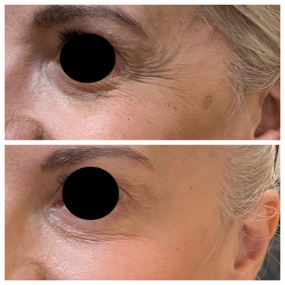 Injectables - Discover the transformative effects of neuromodulators. Our treatments target and relax specific facial muscles, effectively reducing the appearance of wrinkles and fine lines. Choose from our list of FDA-approved products.
Neuromodulators
Neuromuscular blocking agents are botulinum based. They help to reduce fine lines and wrinkles formed during facial movements and gestures. Some of the most common areas treated are the forehead, frown lines between the eyes/brows (AKA the “11’s”), and the crow's feet around the eye area. They are also used to treat excess sweating in the axillae/hands/feet and migraines, among other things. Effects can last an average of 3-4 months. We only offer FDA approved products. Our goal at Rejuvenate is your satisfaction. We aim for results, not units, and treat per area to achieve this. Touch-ups are included at no additional cost.
HA Dermal Fillers
HA Dermal fillers are a gel-like compound made of Hyaluronic Acid, a naturally occurring product in our body. They come in different consistencies and molecular sizes and are used to boost hyaluronic acid to plump and enhance, fill wrinkles, and shallow contours. They are also used to plump lips or help define/contour facial features. They soften facial creases, decrease wrinkles, and restore a smoother, younger appearance. The most common areas treated are the lips, nasolabial folds (laugh lines), marionette lines, and cheeks. Dermal fillers can last from 6 months up to 2 years, depending on the specific product used. We only offer FDA-approved products and will only use the best products for your specific needs.
HA Filler Reversal
Undo the unwanted effects of dermal fillers with our specialized reversal services to rediscover your natural beauty and regain control over your appearance.
Biostimulators
Discover the power of biostimulators and indulge in one of our most popular spa treatments. Our treatments have been specifically designed to tighten and lift your skin while boosting collagen production for a youthful glow. Whether using PDO threads, Radiesse, or Sculptra, we are here to optimize your natural features and take your rejuvenation to the next level.
We also offer other more specialized injection sites and require additional training. See our list of Specialty Injections available at Rejuvenate! Injectables - Discover the transformative effects of neuromodulators. Our treatments target and relax specific facial muscles, effectively reducing the appearance of wrinkles and fine lines. Choose from our list of FDA-approved products.
Neuromodulators
Neuromuscular blocking agents are botulinum based. They help to reduce fine lines and wrinkles formed during facial movements and gestures. Some of the most common areas treated are the forehead, frown lines between the eyes/brows (AKA the “11’s”), and the crow's feet around the eye area. They are also used to treat excess sweating in the axillae/hands/feet and migraines, among other things. Effects can last an average of 3-4 months. We only offer FDA approved products. Our goal at Rejuvenate is your satisfaction. We aim for results, not units, and treat per area to achieve this. Touch-ups are included at no additional cost.
HA Dermal Fillers
HA Dermal fillers are a gel-like compound made of Hyaluronic Acid, a naturally occurring product in our body. They come in different consistencies and molecular sizes and are used to boost hyaluronic acid to plump and enhance, fill wrinkles, and shallow contours. They are also used to plump lips or help define/contour facial features. They soften facial creases, decrease wrinkles, and restore a smoother, younger appearance. The most common areas treated are the lips, nasolabial folds (laugh lines), marionette lines, and cheeks. Dermal fillers can last from 6 months up to 2 years, depending on the specific product used. We only offer FDA-approved products and will only use the best products for your specific needs.
HA Filler Reversal
Undo the unwanted effects of dermal fillers with our specialized reversal services to rediscover your natural beauty and regain control over your appearance.
Biostimulators
Discover the power of biostimulators and indulge in one of our most popular spa treatments. Our treatments have been specifically designed to tighten and lift your skin while boosting collagen production for a youthful glow. Whether using PDO threads, Radiesse, or Sculptra, we are here to optimize your natural features and take your rejuvenation to the next level.
We also offer other more specialized injection sites and require additional training. See our list of Specialty Injections available at Rejuvenate!