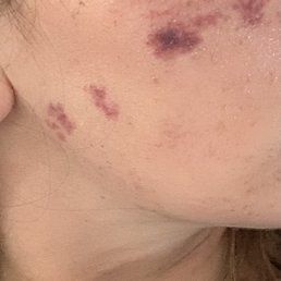 Picture of my cheek two days after BBL treatment.