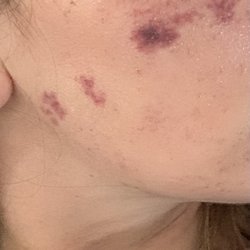 Reviv Med Spa - Picture of my cheek two days after BBL treatment.