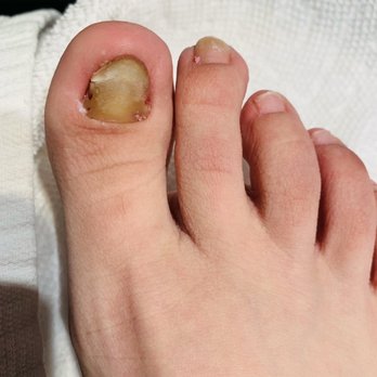 Revive With Thi - Before: right toe - Nail Technicians Near Me - Los Angeles, California Revive With Thi - Before: right toe - Nail Technicians Near Me - Los Angeles, California