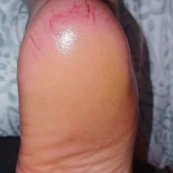 Pretty on Park - My left heel the morning after my pedicure here. - Skin Care Near Me - Rochester, New York Pretty on Park - My left heel the morning after my pedicure here. - Skin Care Near Me - Rochester, New York