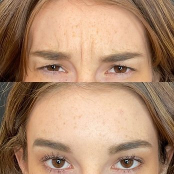 Aesthetics by Heather Weltner - Dysport Results - Medical Spas Near Me - Austin, Texas Aesthetics by Heather Weltner - Dysport Results - Medical Spas Near Me - Austin, Texas