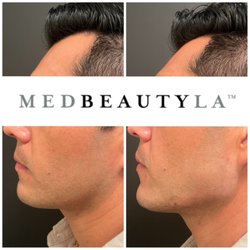 Filler injected in the jaw to give the client a stronger and more defined jaw