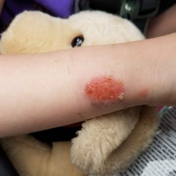 Tommy Nails - Burn 6 days later. - Nail Salons Near Me - Lakewood, Washington Tommy Nails - Burn 6 days later. - Nail Salons Near Me - Lakewood, Washington
