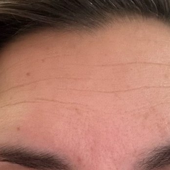 Botox It - Before - Cosmetic Surgeons Near Me - Tustin, California Botox It - Before - Cosmetic Surgeons Near Me - Tustin, California