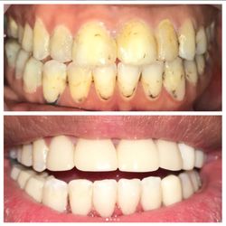 Great Expressions Dental Centers - Fort St - We are all about the patient's needs. This patient can't stop smiling after her drastic makeover!