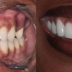 Southern Dental Implant Center - Before & After from Southern Dental Implant Center | Brentwood, TN