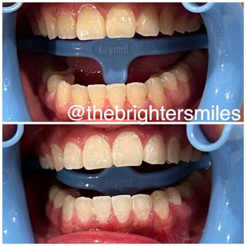 The Brighter Smiles - Before and after one session - Dental Hygienists Near Me - San Jose, California The Brighter Smiles - Before and after one session - Dental Hygienists Near Me - San Jose, California
