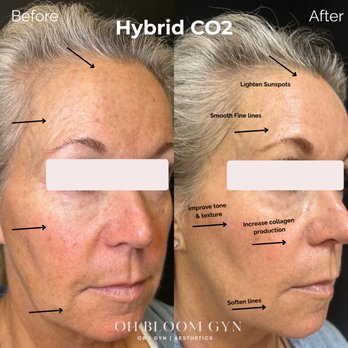 Oh Bloom Gyn - Hybrid CO2 laser for skin resurfacing - Obstetricians & Gynecologists Near Me - Tustin, California Oh Bloom Gyn - Hybrid CO2 laser for skin resurfacing - Obstetricians & Gynecologists Near Me - Tustin, California