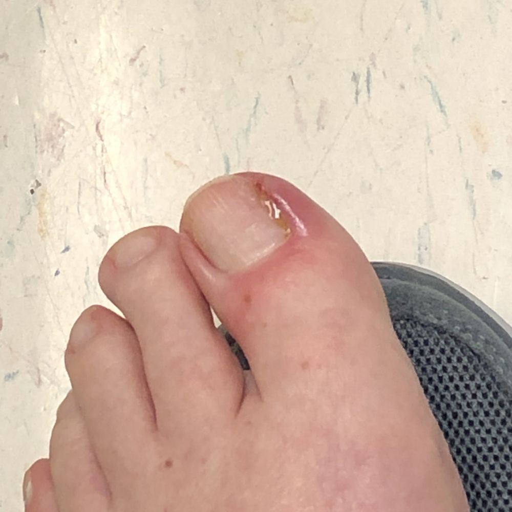 At Patient First with an infected to after my pedicure. The picture speaks for itself.
