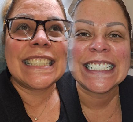 Teeth Whitening by Philly Permanent Makeup Studio - Teeth Whitening by Philly Permanent Makeup Studio