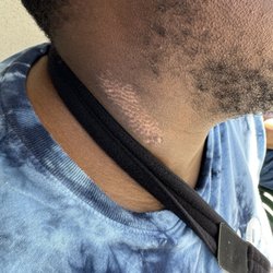 St. Joseph's Behavioral Health Center - His neck was flaming red with blood prior to getting sling for his arm. This is not from the sling.