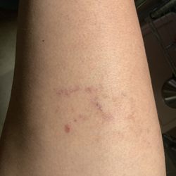 Venus Fashion - Jeans caused burns on leg. Company said get a lawyer.