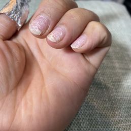 Those white lines are layers of my own nails. Plastic forced so hard & far in it ripped and cut through my nail. Disappointed Those white lines are layers of my own nails. Plastic forced so hard & far in it ripped and cut through my nail. Disappointed