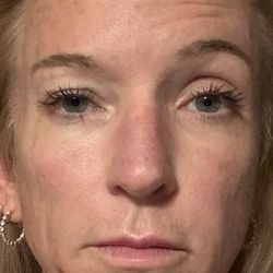 Bayou City Dermatology - facerelaxedinpic $4.4k+ is high dollar for low results . Told $850 more to correct Clinic refuses med records