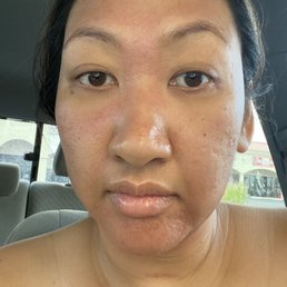 Post microneedling right after. Post microneedling right after.