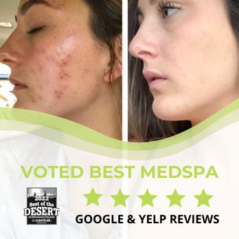 Uptown Medispa - Clinical Facial Results - Medical Spas Near Me - Chandler, Arizona Uptown Medispa - Clinical Facial Results - Medical Spas Near Me - Chandler, Arizona
