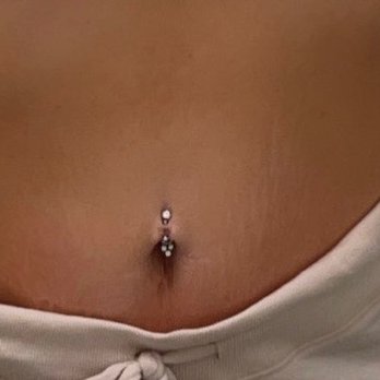 Viva La Med Spa - My stomach prior to the C02 laser treatment - lightly faded stretch marks. - Medical Spas Near Me - Chicago, Illinois Viva La Med Spa - My stomach prior to the C02 laser treatment - lightly faded stretch marks. - Medical Spas Near Me - Chicago, Illinois