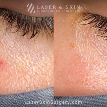 Laser & Skin - Laser treatment to remove red mark under the eye - Dermatologists Near Me - Devon, Pennsylvania Laser & Skin - Laser treatment to remove red mark under the eye - Dermatologists Near Me - Devon, Pennsylvania