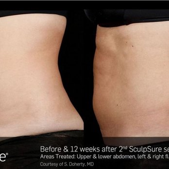 Sollay Laser Center - Want to get rid of stubborn fat but don't have time to go to the gym? Let Sollay get you in shape and fit before summer with no downtime! - Laser Hair Removal Near Me - Baltimore, Maryland