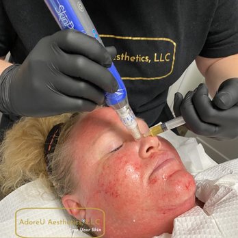 AdoreU - Microneedling with PRP stimulates your body's regeneration system goes into overdrive and you produce collagen and elastin at amazing rates! - Medical Spas Near Me - O'fallon, Missouri AdoreU - Microneedling with PRP stimulates your body's regeneration system goes into overdrive and you produce collagen and elastin at amazing rates! - Medical Spas Near Me - O'fallon, Missouri