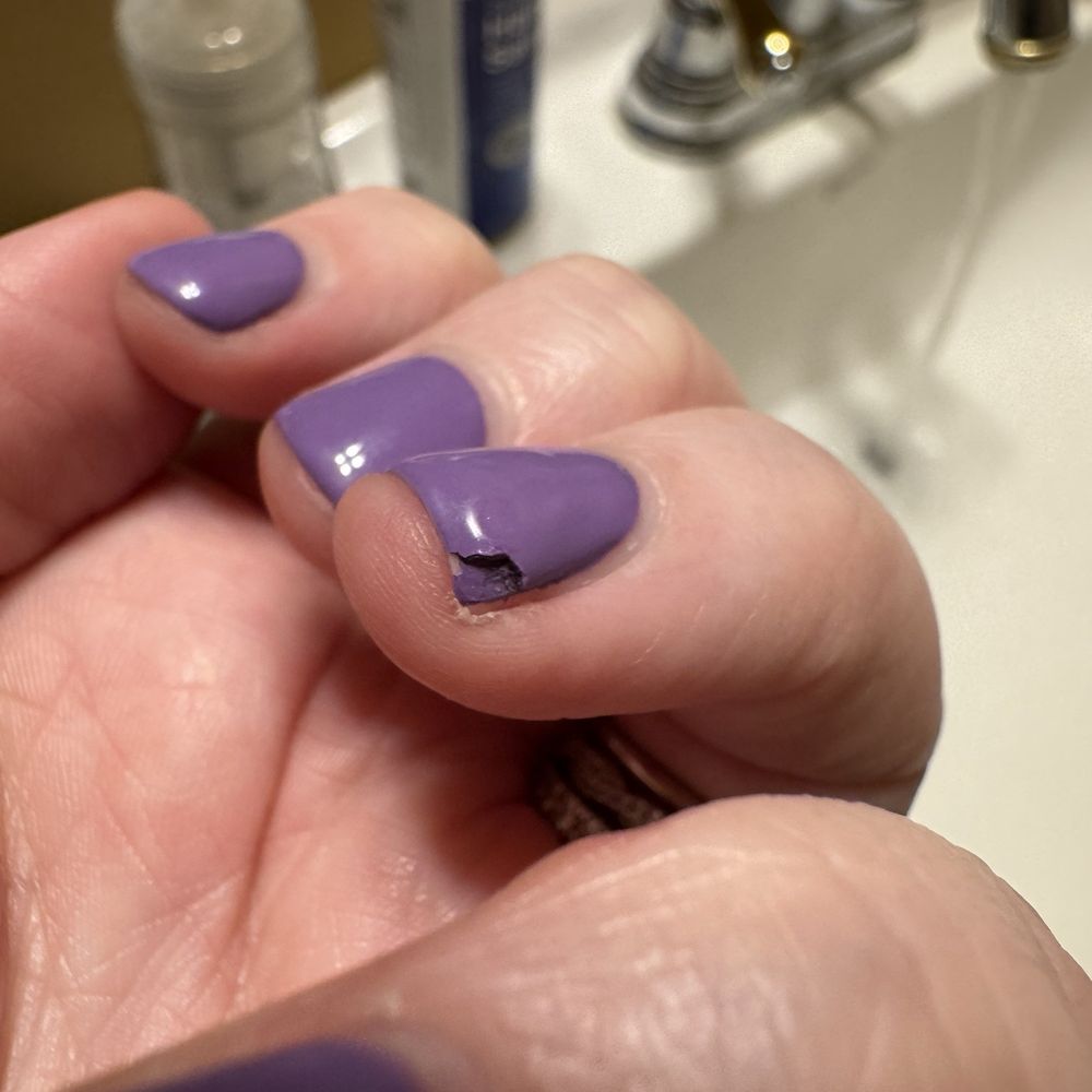 Polish peeling 5 days later Polish peeling 5 days later